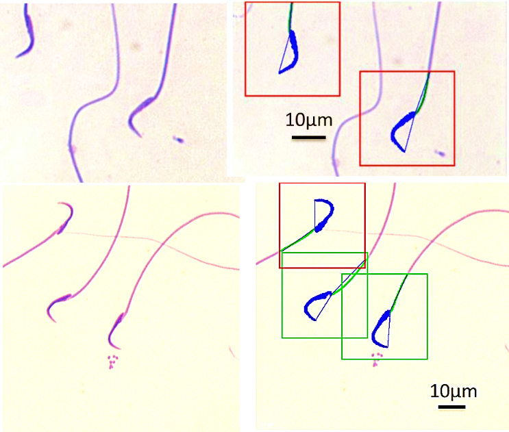 Fig. 2: Red blocks (abnormal) and green blocks (normal) sperm on right hand side showing automated analysis of sperm shown on the left hand side.